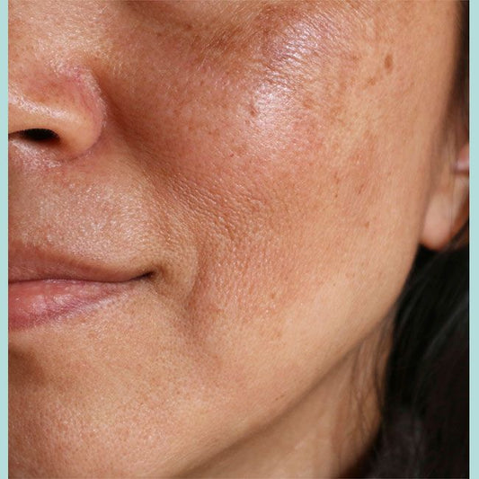 Dull Skin even in Summer! Why? Decoding in-depth by Novaskins