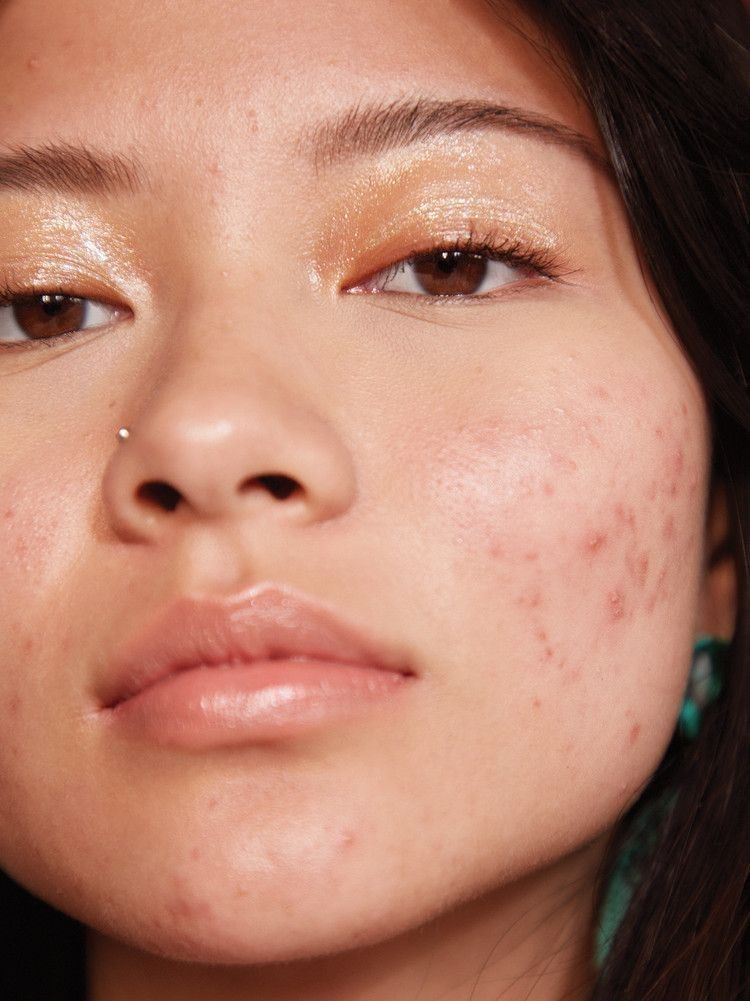 Why Is My Skin So Oily, and What Can I Do About It?