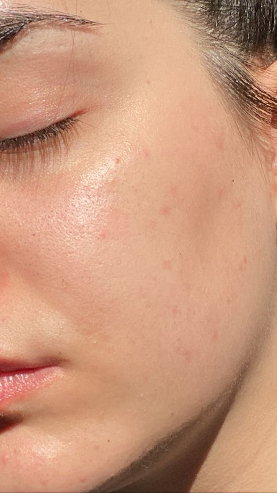 Saving Your Skin This Winter: Healing Extreme Dryness